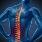 Spondylitis